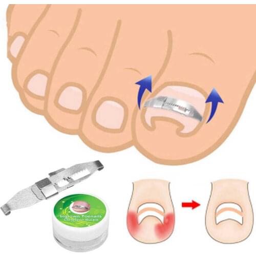 Stainless Steel Ingrown Toenail Corrector Pain Relief Paronychia Treatment Correcting Tool Wire Fixer Pedicure Foot Care Tool