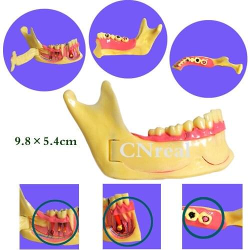 1 Piece Mandible Teeth Pathology Model for Dental Teaching Resin
