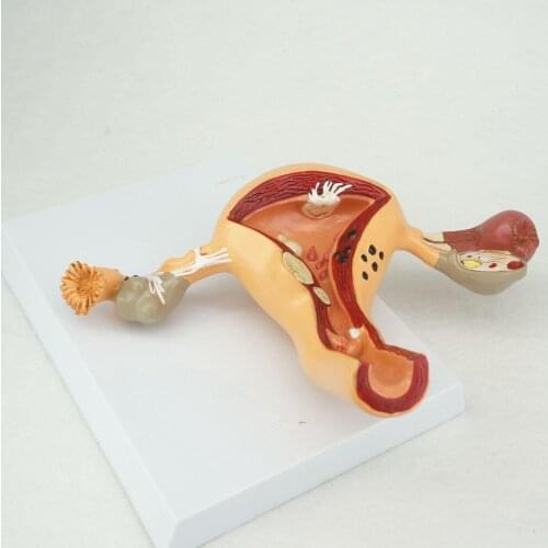Pathological Uterus and Ovary Anatomical Model Human Female Medical Anatomy Learning Kit Teaching Resources