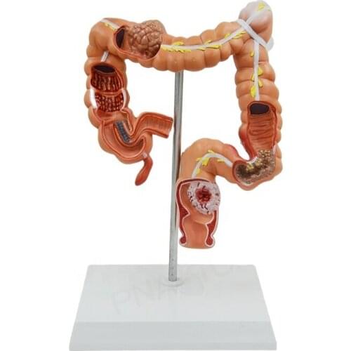 Human Digestive System Organ Anatomy Diseased Large Intestines PNT-07451 Medical Supplies and Equipment Anatomical Model