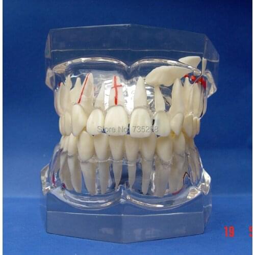 Pathological Model 2 x Magnification Adult teeth,Crystal Material is Qualitative Tooth Pathological Teaching Model