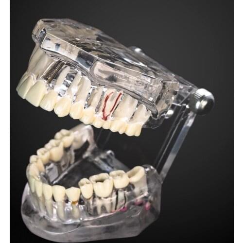 Transparent Disease Dental Model Teeth Implant Restoration Bridge Teaching Study Tooth Dentist Research Communication