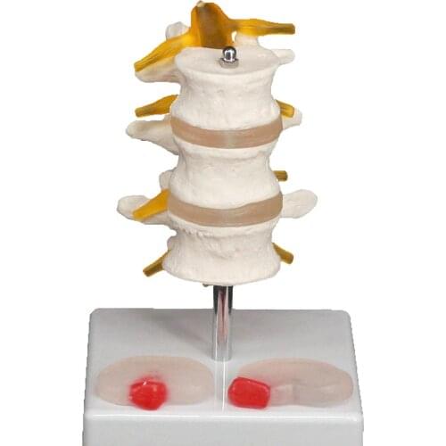 Human Three Lumbar Lesions Intervertebral Disc Skeleton Spine Medical Model Teaching Aid