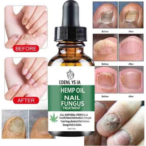 Nail Fungal Treatment Serum Onychomycosis Paronychia Anti-Fungal Nail Infection Herbal Toe Fungus Foot Repair Essence Oil Care