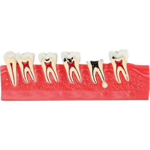 1set Dental caries classify Tooth model Demonstration Teach and Study teeth caries Evolution decayed tooth Analysis Model