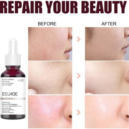 Face Serum Anti Acne Exfoliating Peeling Solution Pore Shrinking Serum Oil-Control Firming Moisturizing Repairing Smoot TSLM1