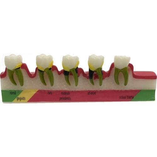 Dental Periodontal Disease Assort Tooth Typodont Model