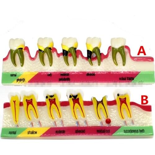 Dental Model Periodontal Disease Assort Tooth Typodont Teach Model 2 type to choose