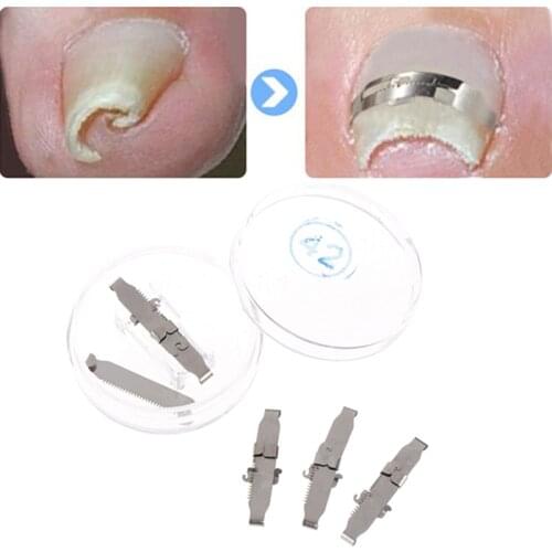 Ingrown Toe Foot Nail Correction Fixer Nail Pedicure Tool Toenail Corrector New