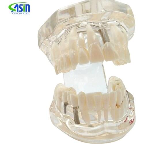 Transparent Disease Teeth Model Dental Implant Teeth Model Dentist Dental Student Learning, Teaching, Research Communication