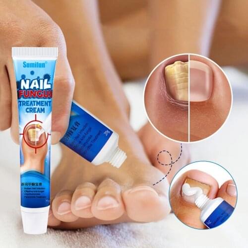 Pedicure Fungus Removal Cream Onychomycosis Fungal Nail Treatment Paronychia Anti Infection Feet Toe Fungal Nail Care Ointment