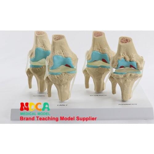 Four type knee joint normal knee bone disease combined model skeleton model Department of orthopedics medical teaching MGJ007