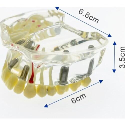 Dental Implant Upper Jaw Model With Bridge & Caries Dental Study Teach Teeth Model