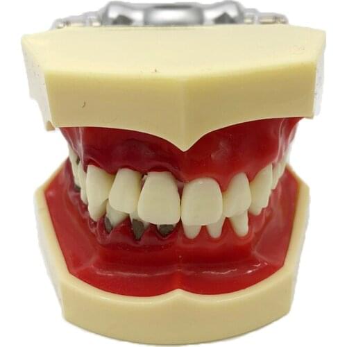 1pcs Periodontal Pathological Model Practice Supragingival Subgingival Scaling Calculus Model Student Learning Teaching Model