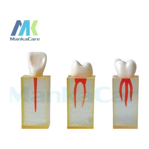 Manka Care - 3 pcs Teeth with colored pulpal wall and crowns.Excellent for developing access opening and endo filling procedures
