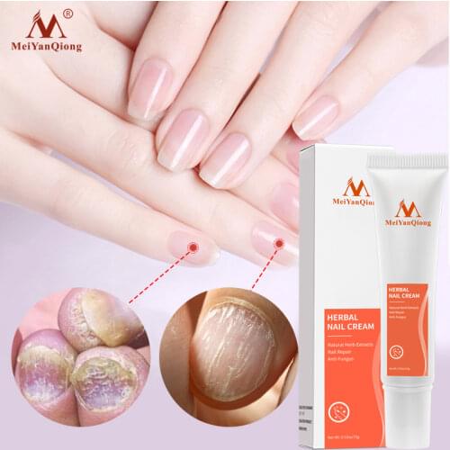 Herbal Nail Treatment Onychomycosis Paronychia Anti Fungal Nail Infection Good Result Chinese Herbal Toe Nail Fungus Treatment