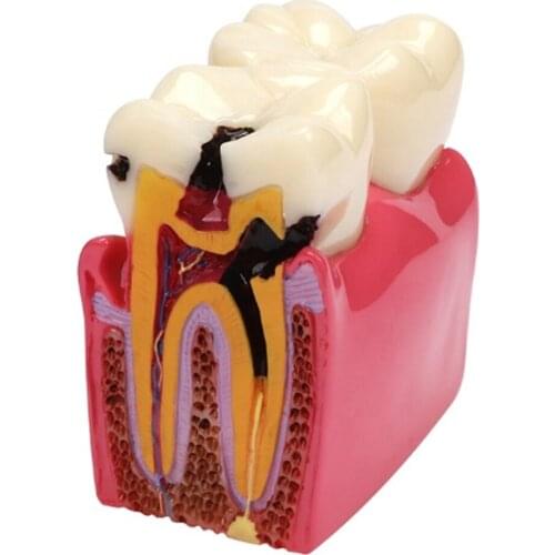 Teaching use M4021 Caries Model/Dental Anatomy EducationTeeth Model M4021 for Dental Lab