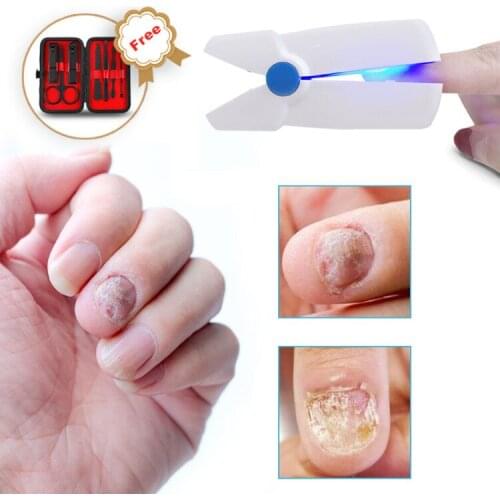 Nail Fungus Remover Painless Therapy Treatment For Toes And Fingernails cold laser and blue LED light therapy for onychomycosis
