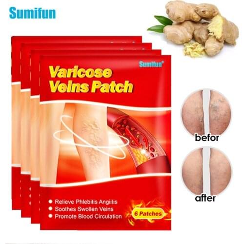 60pcs Sumifun Varicose Veins Patches Leg Vasculitis Phlebitis Spider Anti-swelling Angiitis Removal Chinese Medical Plaster