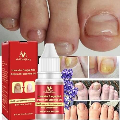 10ml Naik Oil Fungal Nail Treatment Serum Anti-fungal Onychomycosis Fungus Toe Nail Care Infection Paronychia Repair Nail L0C7