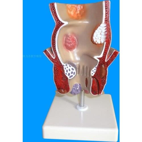 Rectal Lesion Model Internal and External Anorectal Rectal Pathology Model