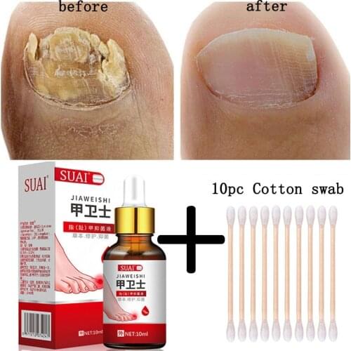 Fungal Treatment Feet Nail Care Essence Nail Foot Whitening Toe Nail Fungus Removal Gel Anti Infection Paronychia Onychomycosis