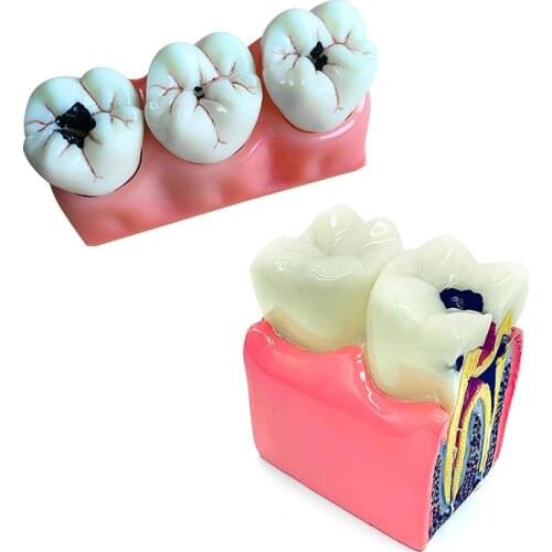 Dental Model Caries Model Dental Teeth Model for Teeth Disease Demonstration Model