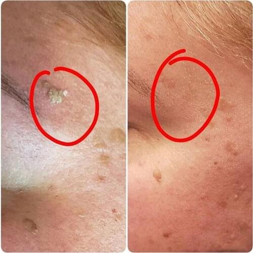 10/20/30ml Skin Tag Remover Mole Foot Corn Wart Care Essence Essence Pure Acid 100% Hyaluronic Oil Serum Natural N6A7