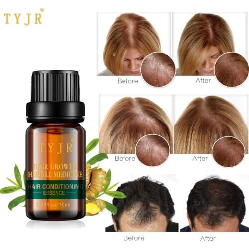 Powerful Hair Growth Serum Natural Essence Stimulate Healthy Hair Grow Receding Hair Line Prevent Hair Loss Oil