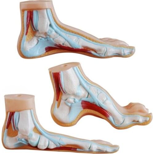 BIX-A1069 Normal Foot Flat Foot Bow Foot Anatomy Model WBW151