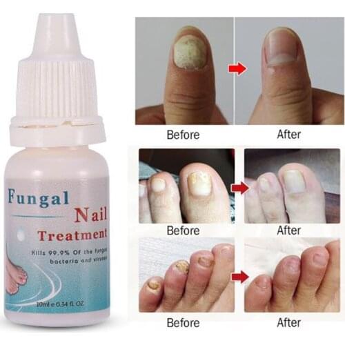 3/4/5 PCS Nail Repair Serum Eliminate Fungus Onychomycosis Armor Rapid Sterilization Moisturizing Liquid For Foot Nails Care