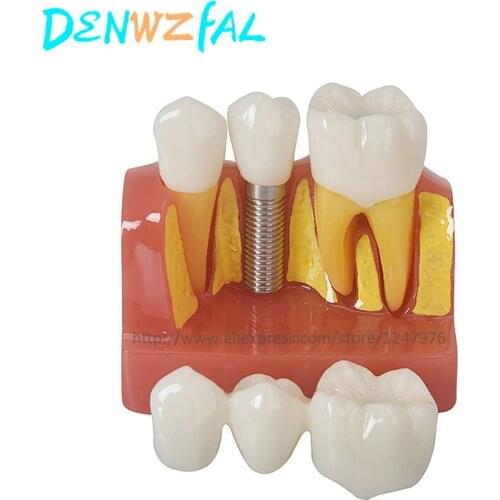 Four-fold implant interpretation model for dental teaching learning decomposition model