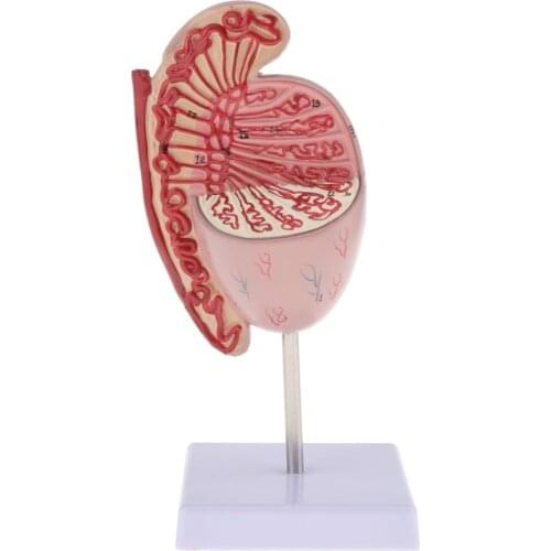 Life Size Human Kidney Diseased Model Anatomical Anatomy Diseased Pathological Stone Organ Teaching Supplies