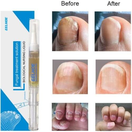 3 ML Fungal Nail Repair Pen Gentle High Penetration No Irritation Onychomycosis Paronychia Anti Fungal Nail Care Liquid Tool