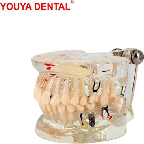 Dental Teeth Model For Studying Teaching Transparent Tooth Implant Model Adult Pathology Medical Science Oral Dentistry Products