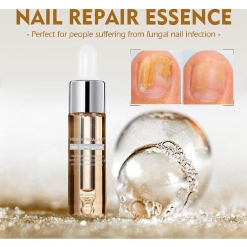 VIBRANT GLAMOUR Fungal Nail Treatment Essence Toe Care Repair Serum Feet Fungus Removal Anti Infection Paronychia Onychomycosis