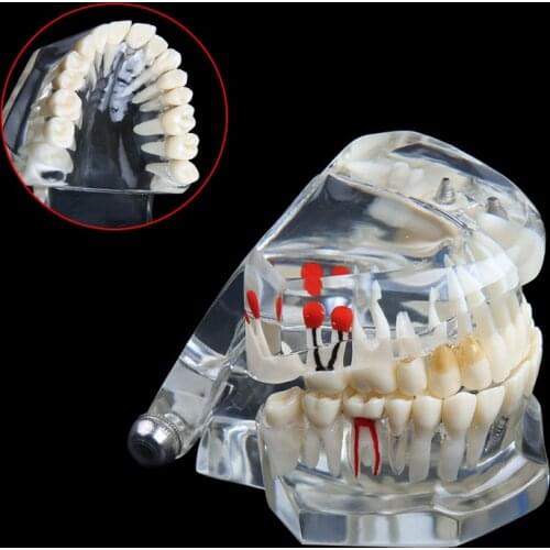 Dental Implant Disease Teeth Model With Restoration Bridge Tooth Dentist For Medical Science Dental Disease Teaching Study