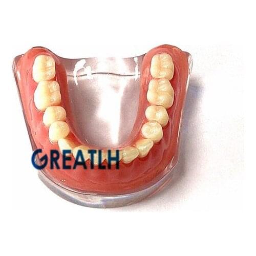 6pcs /pack mandibular model with Silver bar Overdenture implant model Denture Teeth Dental Teaching study Model