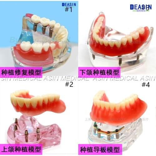 1 pc x high quality Resin Coverage dental implant model dentures Removable teeth model for dentist study Deasin