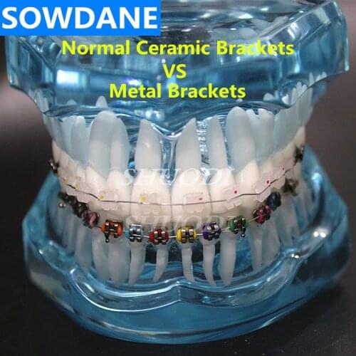 Dental Orthodontic Model Patient Communication 2 kinds Brackets with Archwires Ligatures Ceramic Bracket Metal Bracket