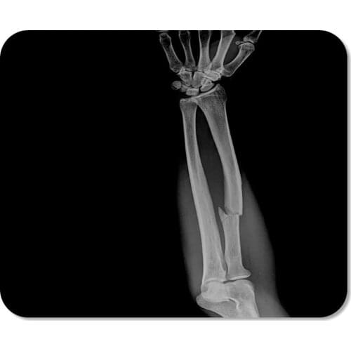 Mousepad Computer Notepad Office Arm X Ray Forearm Ap Show Fracture Shaft of Ulnar Forearms Bone Broken Home School Game