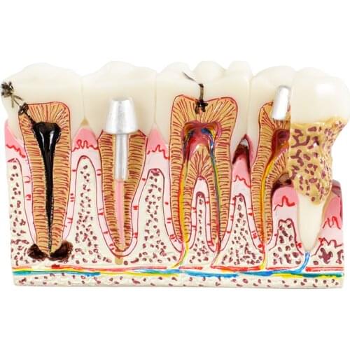 Dental Pathologies teeth Model M4029 shows root canal treatment Caries study tooth Model for dentist