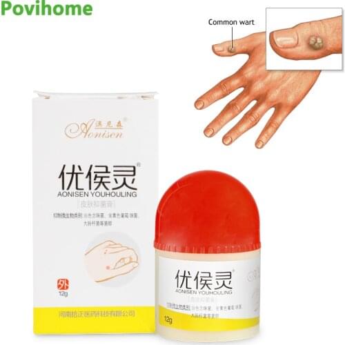 12g Body Warts Treatment Cream Skin Care Tag Remover Ointment 100% Herbal Medicine Warts Ointment Foot Corn Removal Plantar