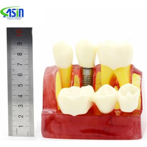 MACRO IMPLANT TEETH MODEL CROWN BRIDGE DEMOSTRATATION TEETH TOOH TYPODONT DENTOFORM