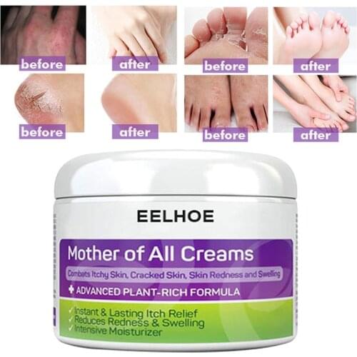 EELHOE Eczema Cream Face Care Plant Rich Formula Instant Moisturizing Long Lasting For Dry Cracked or Irritated Skin Care TSLM2