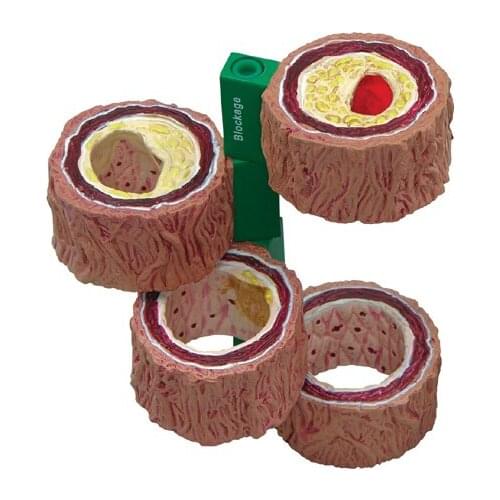 Free shipping Atherosclerosis with vascular thrombosis process model Thrombosis model Vascular anatomical model