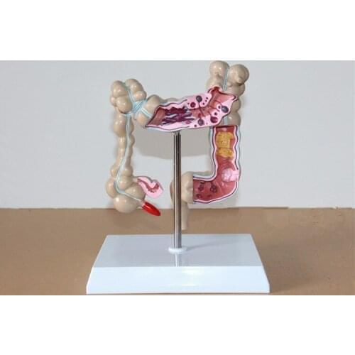 4D Life Size Human Colon Disease Model the Large Intestine Pathological Model Gastroenterology Aids Anatomical Medical Skull