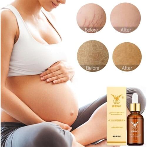 Stretch Marks Removal Essential Oils Pure Natural Stretch Marks Remover Obesity Postpartum Anti-wrinkle Repair Cream Skin Care