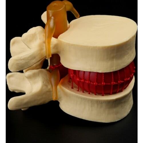 Anatomical Spine Lumbar Disc Herniation Anatomy Teaching Tool