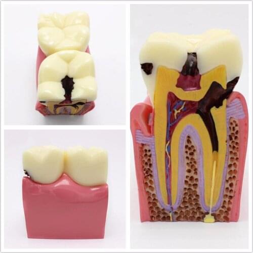 Dental Oral Model 6 Times Dental Caries Comparison Model Dental Tooth Model 1pc